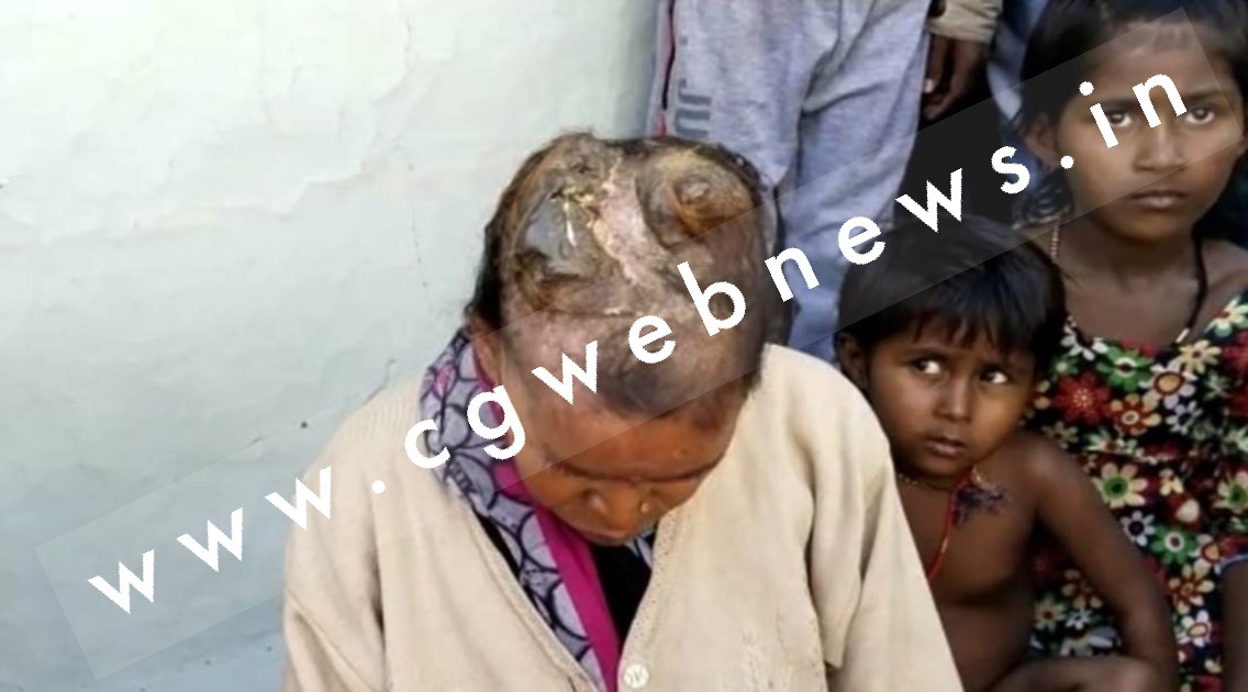 60 साल की महिला के सिर से निकला सींग , डॉक्टर हैरान , परिवार परेशान , इलाज के लिए लगाई मदद की गुहार